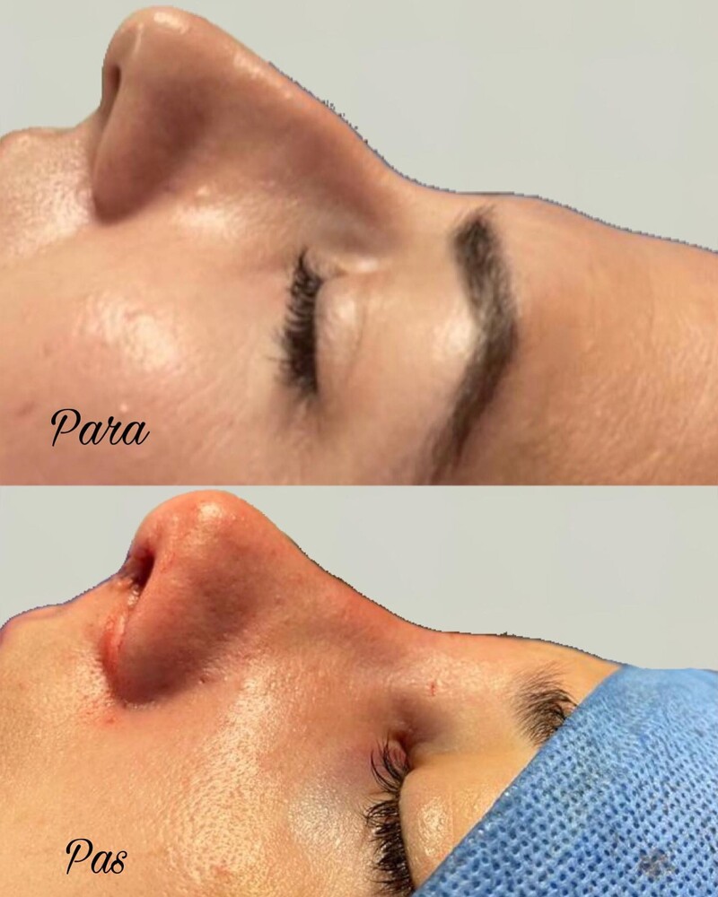 Before and After Result